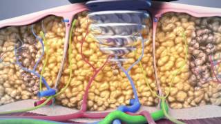 non surgical lipo animation [upl. by Rabkin515]