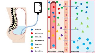 Peritoneal Dialysis [upl. by Placido]