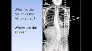 Scoliosis How to medically classify scoliosis the Lenke System for AIS [upl. by Shirleen]