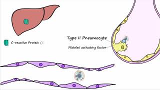 Bacterial Pneumonia  Pathogenesis [upl. by Elokyn]