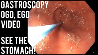 Gastroscopy  OGD  See inside the stomach [upl. by Yendroc]