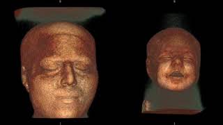 Lissencephal Brain VS normal Brain using MRI [upl. by Ahsilad]