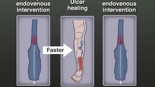 Treating Venous Leg Ulcers [upl. by Singer]