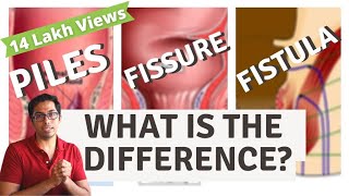 Piles  Fisure  Fistula  Difference explained  Dr Vishal Tomar  Open Consult [upl. by Brenn622]