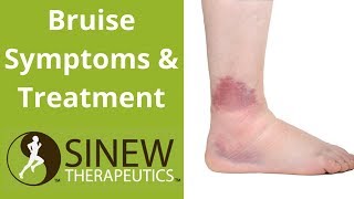 Bruise Symptoms and Treatment [upl. by Glenn]