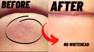 How To Remove Whiteheads And Blackheads From Chin At Home [upl. by Sean777]