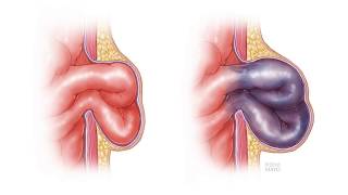 Colorectal Polyps Causes Signs and Symptoms Diagnosis and Treatment [upl. by Cila]