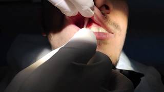 Maxillary Infiltration Anesthesia Technique [upl. by Tserrof]