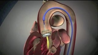 Transcatheter Aortic Valve Implantation TAVI [upl. by Meri457]