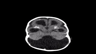 How Genetic Defects Cause Microcephaly [upl. by Cloe689]