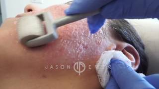 Dermaroller  Microneedling Acne Scars  Skin Resurfacing  Los Angeles California [upl. by Zanze887]