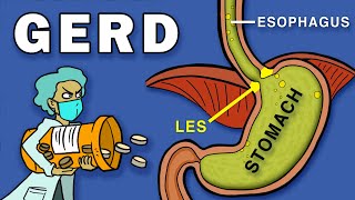 Gastroesophageal Reflux Disease GERD [upl. by Etiam]