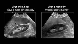 GI Imaging  Hepatic Steatosis and Cirrhosis [upl. by Maurizio]