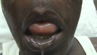 Emergency Nasopharyngoscopy for Angioedema Evaluation [upl. by Yle]