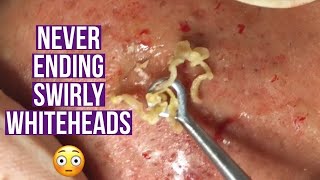 Blackhead and whitehead extractions relaxing amp satisfying [upl. by Namor662]