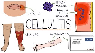 Understanding Cellulitis Skin and Soft Tissue Infections [upl. by Arden]