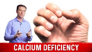 Causes amp Symptoms Of Calcium Deficiency – Dr Berg [upl. by Leventhal]