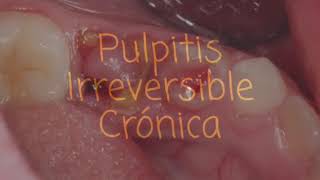 Pulpitis Irreversible [upl. by Egamlat]