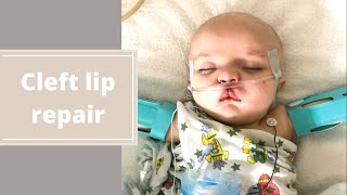 CLEFT LIP REPAIR Basic surgery and recovery information [upl. by Dillie]