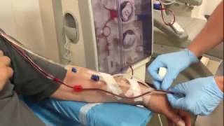 Dialysis connection of a patient with an arteriovenous fistula [upl. by Chapland]