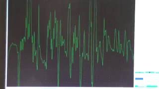 Myopathy EMG changes explained [upl. by Okiram]