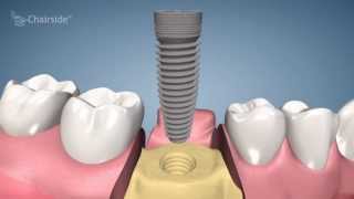 Dental Implant Procedure  One Stage [upl. by Kcirrem617]