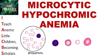 MICROCYTIC HYPOCHROMIC ANEMIA Causes Mechanism amp Approach [upl. by Heinrik]