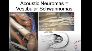 A Rare Brain Tumor Affecting Hearing amp Balance  Acoustic Neuroma [upl. by Nollid]