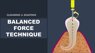 Balanced Force Technique  Cleaning and Shaping [upl. by Croix766]