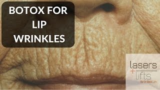 BOTOX for lip wrinkles [upl. by Angi]