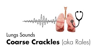 Coarse Crackles Rales  Lung Sounds  Medzcool [upl. by Enytsirk]