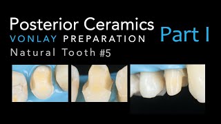 Zirconia Ceramics Part 1 Vonlay Preparation 5 Natural Tooth [upl. by Maureene]