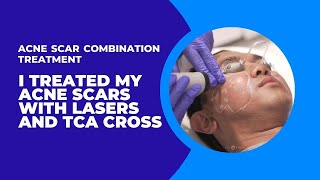 I TREATED MY ACNE SCARS WITH LASERS AND TCA CROSS  ACNE SCAR COMBINATION TREATMENT  Dr Jason Emer [upl. by Bethanne]