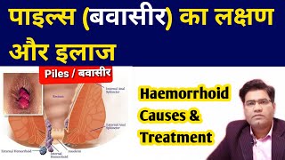 What Are Piles HEMORRHOIDS Causes Symptoms and Treatment  in Hindi [upl. by Enirod313]