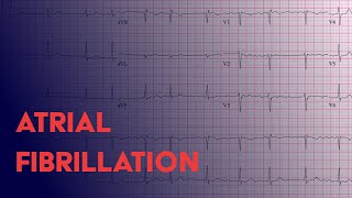 Atrial Fibrillation Afib  EKG ECG Interpretation [upl. by Knutson]