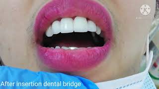 Inserting Dental Zirconia Bridge in the Upper Frontal Teeth [upl. by Tressa]