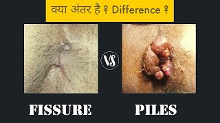 Piles vs Fissure  Difference [upl. by Redford]