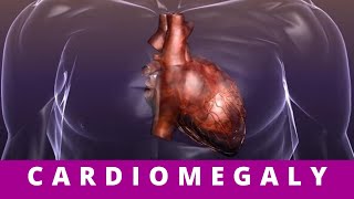 CARDIOMEGALY what causes cardiomegaly [upl. by Etnaled]