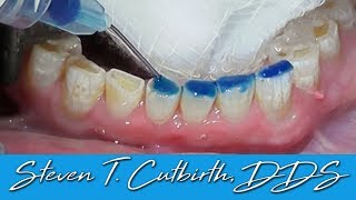 Bonding Worn Anterior Teeth  Dental Minute with Dr Steven T Cutbirth DDS [upl. by Ruffo]