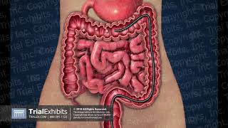 Colonoscopy  Polyp Removal [upl. by Rasec]