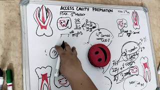 access cavity preparation  premolar amp molar [upl. by Nosyerg]