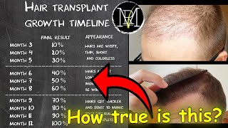 Norwood VI Hair Transplant Results  Feller amp Bloxham Medical  NY NYC Long Island [upl. by Stacy272]