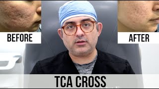 TCA Cross Acne Scar Treatment Before VS After [upl. by Aizatsana840]