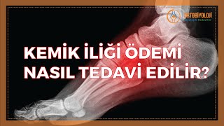 KEMİK İLİĞİ ÖDEMİ NASIL TEDAVİ EDİLİR [upl. by Alhsa]