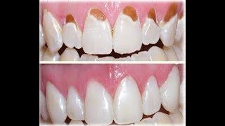 Tooth enamel loss amp How to repair tooth enamel [upl. by Etnahsa441]