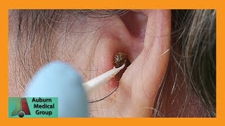 Chunky Earwax Removal  Auburn Medical Group [upl. by Ayeki]