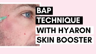 Mesotherapy for Glowing Skin  BAP Technique with Hyaron Skin Booster Ft Vanidiy [upl. by Adnamaa932]