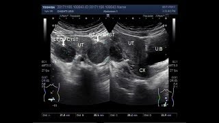 Ultrasound Video showing bilateral ovarian cysts [upl. by Nodgnal]