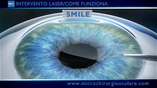 Intervento Laser Occhi Come Funziona [upl. by Novhaj423]