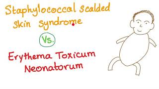 Staphylococcal Scalded Skin Syndrome VS Erythema Toxicum Neonatorum [upl. by Xonk]